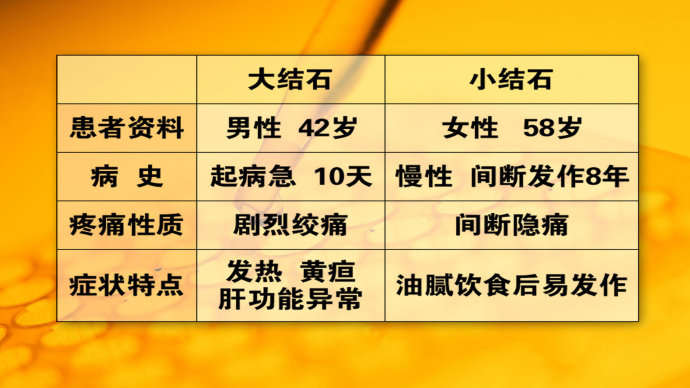 北京协和医院外科主任医师何小东 胆结石介绍,影视