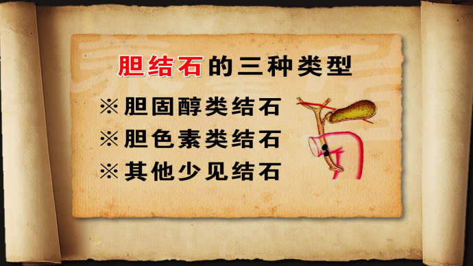 北京协和医院外科主任医师何小东 胆结石介绍,影视