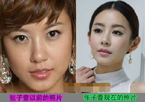 张子萱承认整容 张子萱整容前后对比照片
